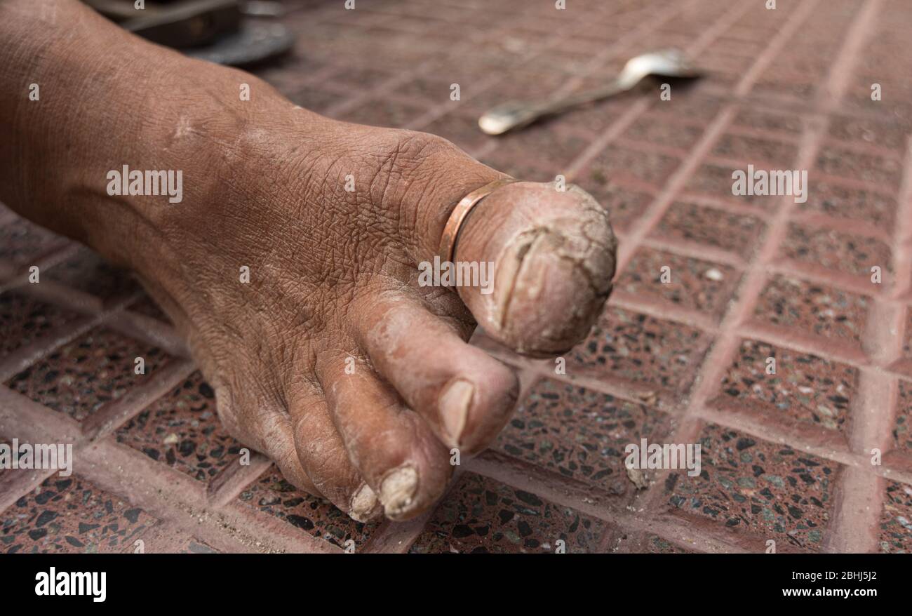 Questo piede con micosys, appartiene ad un artigiano dalle strade di San Telmo, Buenos Aires Foto Stock