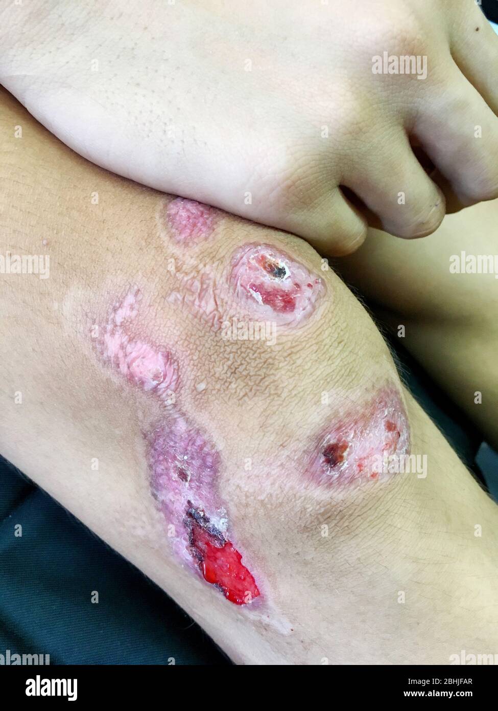 La ferita della carne scabbia sulle ginocchia e cicatrice a causa di caduta Foto Stock