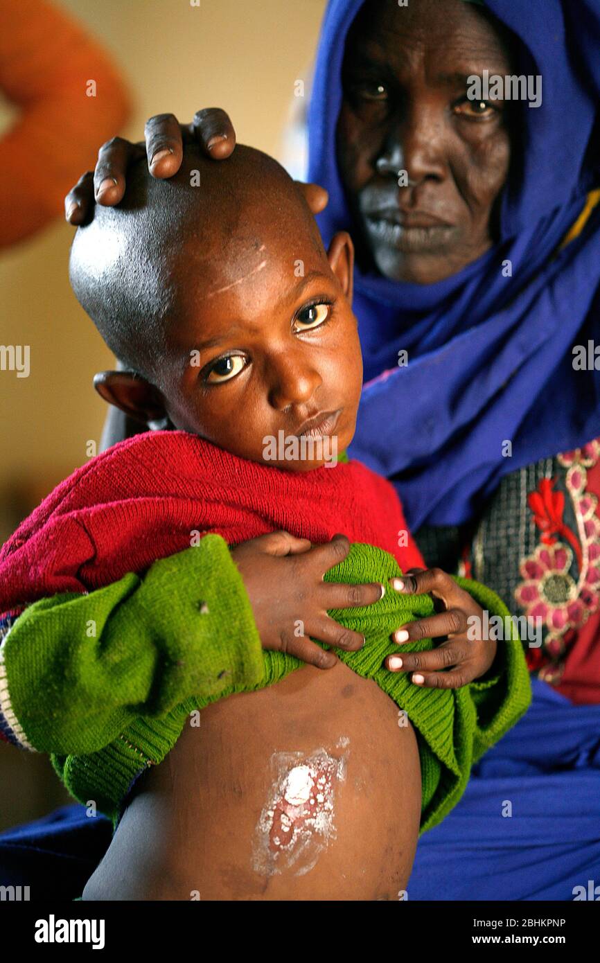 Un ragazzo che soffre di lebbra, il bambino ha una piccola abcessa sull'addome. La lebbra non ha ancora completamente influenzato i suoi arti o nervi, bruno Foto Stock