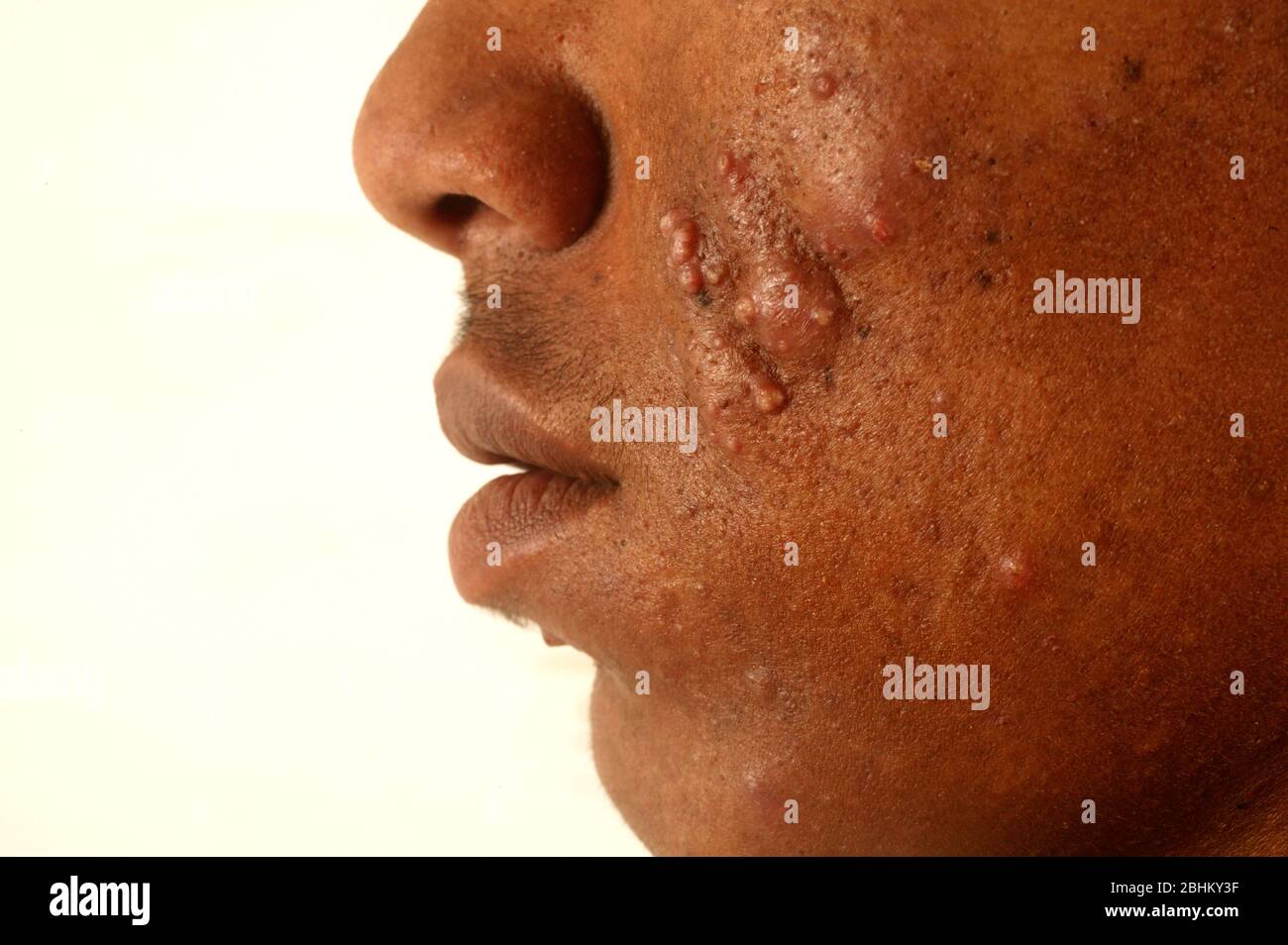 Vista laterale della metà inferiore della faccia di un maschio di 21 anni che soffre di acne vulgaris. L'acne vulgaris è un disordine della pelle che è causato dal blo Foto Stock