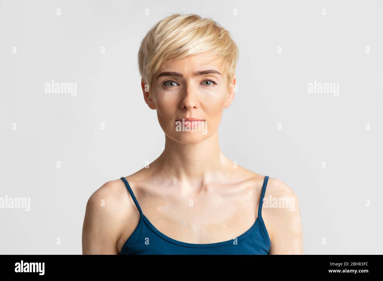 Ritratto di donna con mancanza di pigmento in pelle Foto Stock