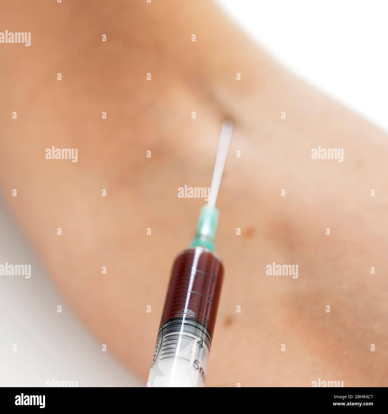 siringa nel braccio paziente prelievo di campioni di sangue per l'analisi del sangue Foto Stock