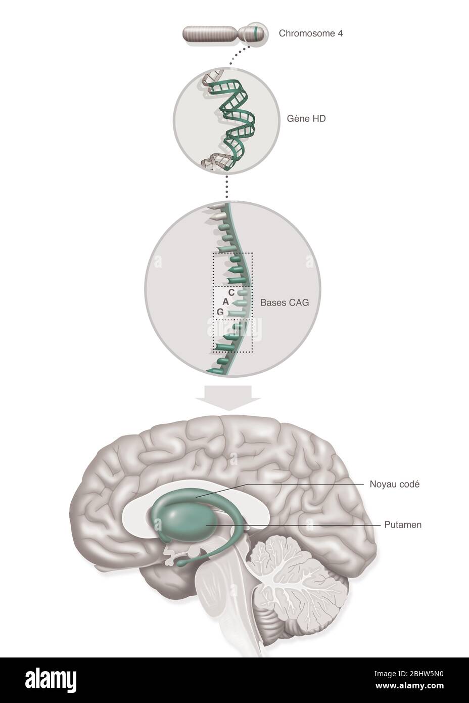 Illustrazione medica che rappresenta la malattia di Huntington, un disturbo genetico che coinvolge il gene HD (malattia di Huntington) del cromosoma 4 con re anormale Foto Stock