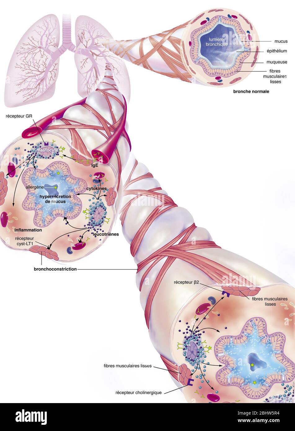 Asma, bronchiolo normale, bronchiolo asmatico con broncocostrizione, ipersecrezione, trattamenti. Rappresentazione dei polmoni con la t bronchiale Foto Stock