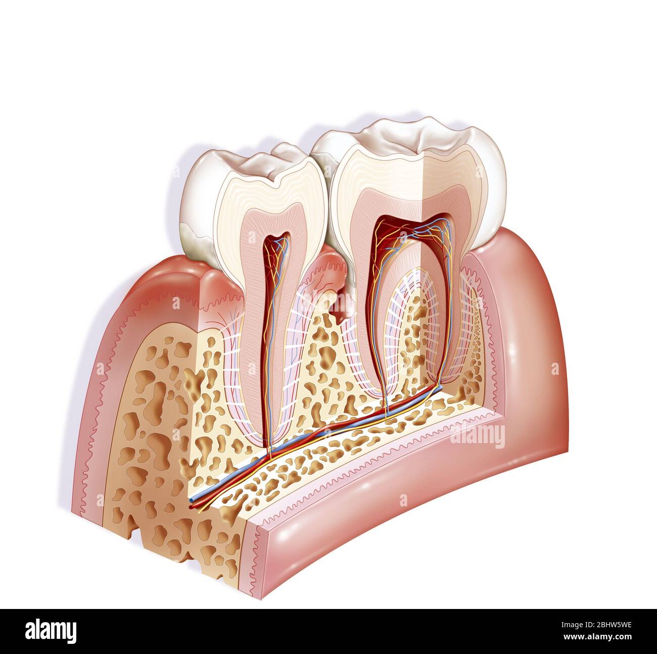 La periodontite è un'infiammazione del periodonzio. Il periodonzio è costituito dai tessuti di supporto dell'organo dentale: La gomma, il cementum, Foto Stock