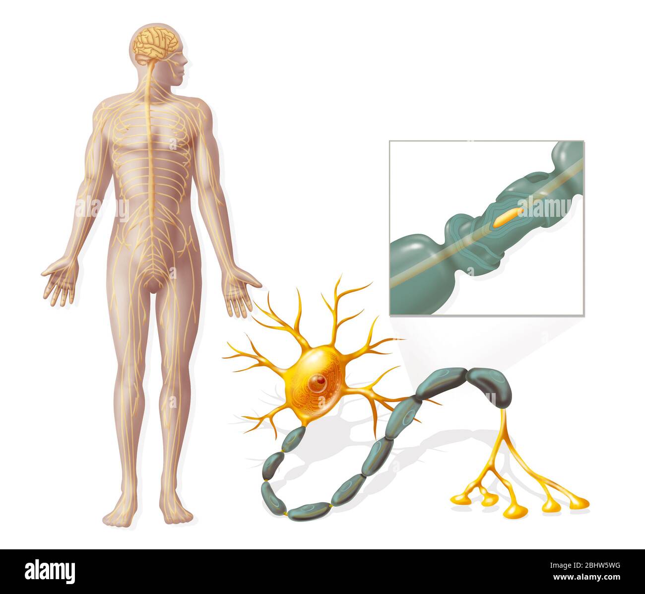 Sindrome di Guillain-Barré, danno ai nervi periferici. I nervi periferici trasmettono informazioni dal cervello o dal midollo spinale (sistema nervoso centrale Foto Stock