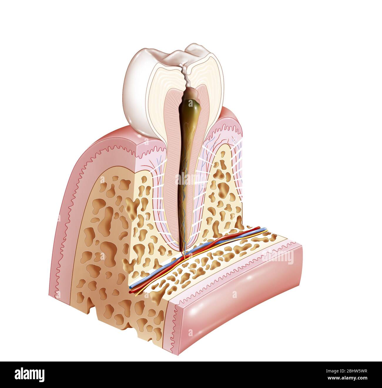 Carie dentali che hanno causato la pulpopatia. Pulpopathy segue una cavità che è passata attraverso lo smalto, dentina e ha raggiunto la polpa. Se lasciato non trattato, esso Foto Stock