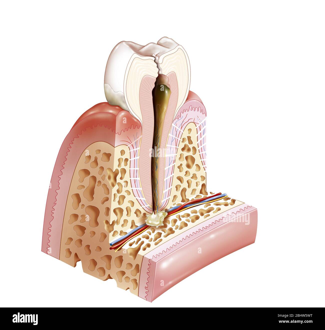 Patologie orali, carie, ascesso dentale, gengivite, tartaro. Questa illustrazione mostra un esempio di alcune patologie orali e dentali. Troviamo da le Foto Stock