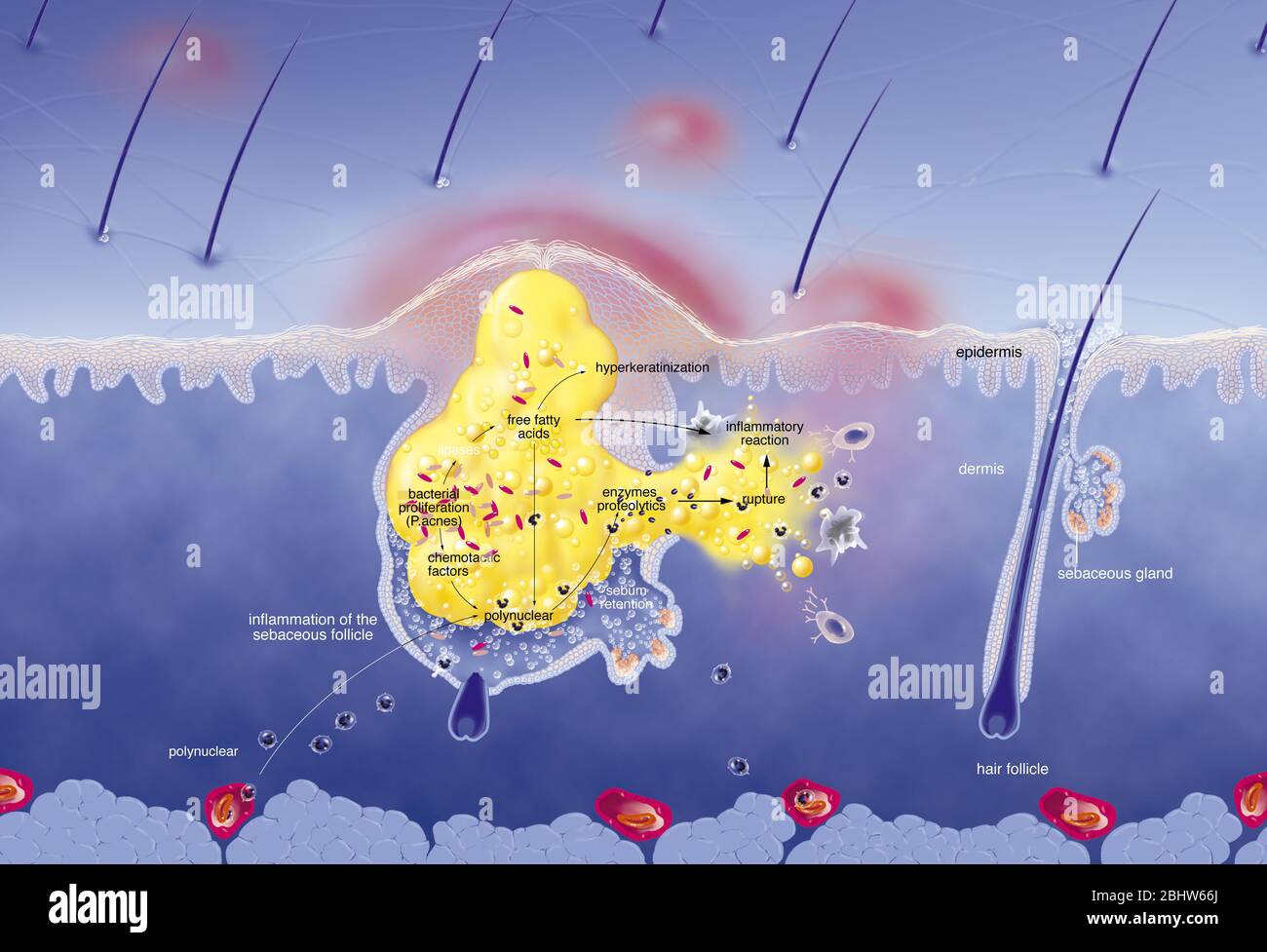 Acne intorno al follicolo dei capelli, ipersecrezione sebacea, ipercheratinizzazione, proliferazione. Sezione cutanea dell'epidermide e del derma. Capelli normali fol Foto Stock