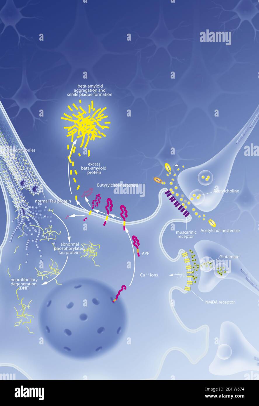 Neurone con grovigli processo di degenerazione, placca senile, trattamenti. Neurone nel sistema nervoso centrale colpiti da anomale la segmentazione di APP Foto Stock