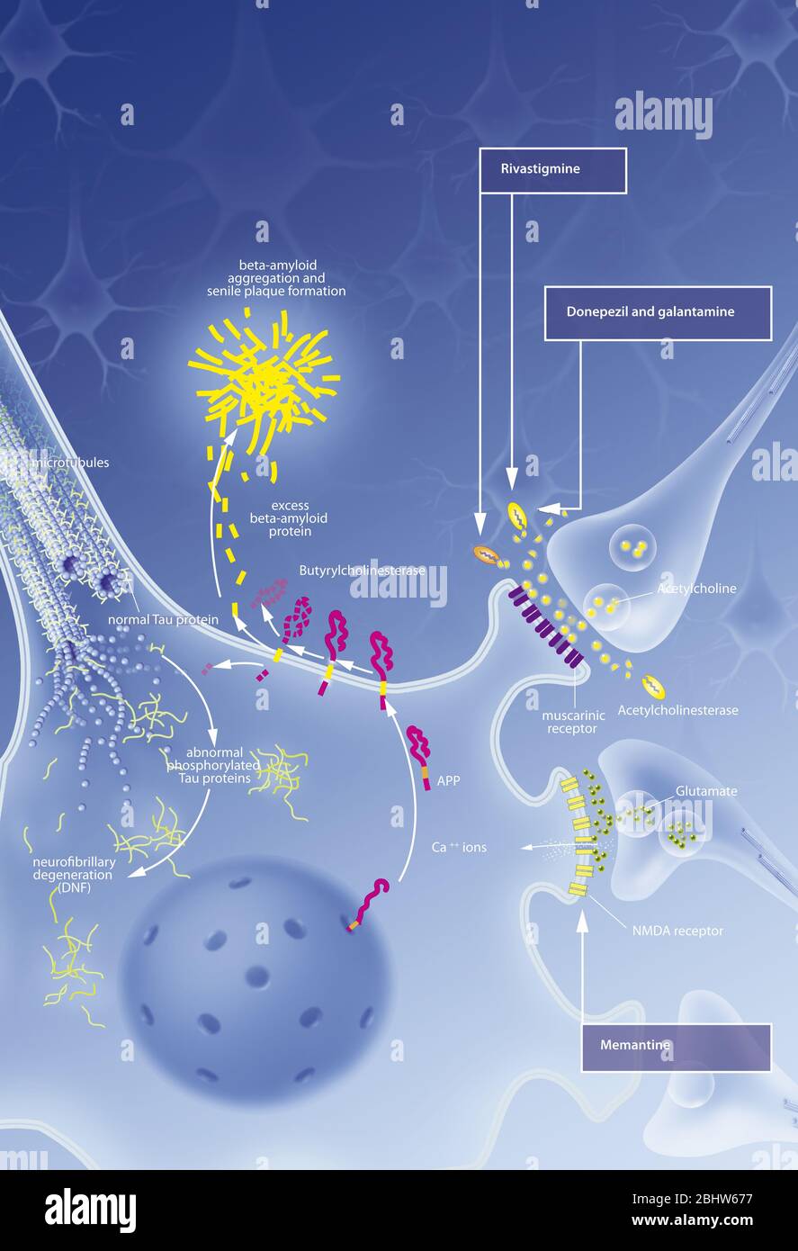 Neurone con grovigli processo di degenerazione, placca senile, trattamenti. Neurone nel sistema nervoso centrale colpiti da anomale la segmentazione di APP Foto Stock