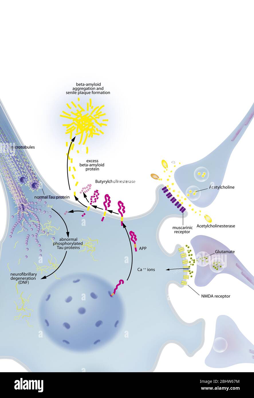Neurone con grovigli processo di degenerazione, placca senile, trattamenti. Neurone nel sistema nervoso centrale colpiti da anomale la segmentazione di APP Foto Stock