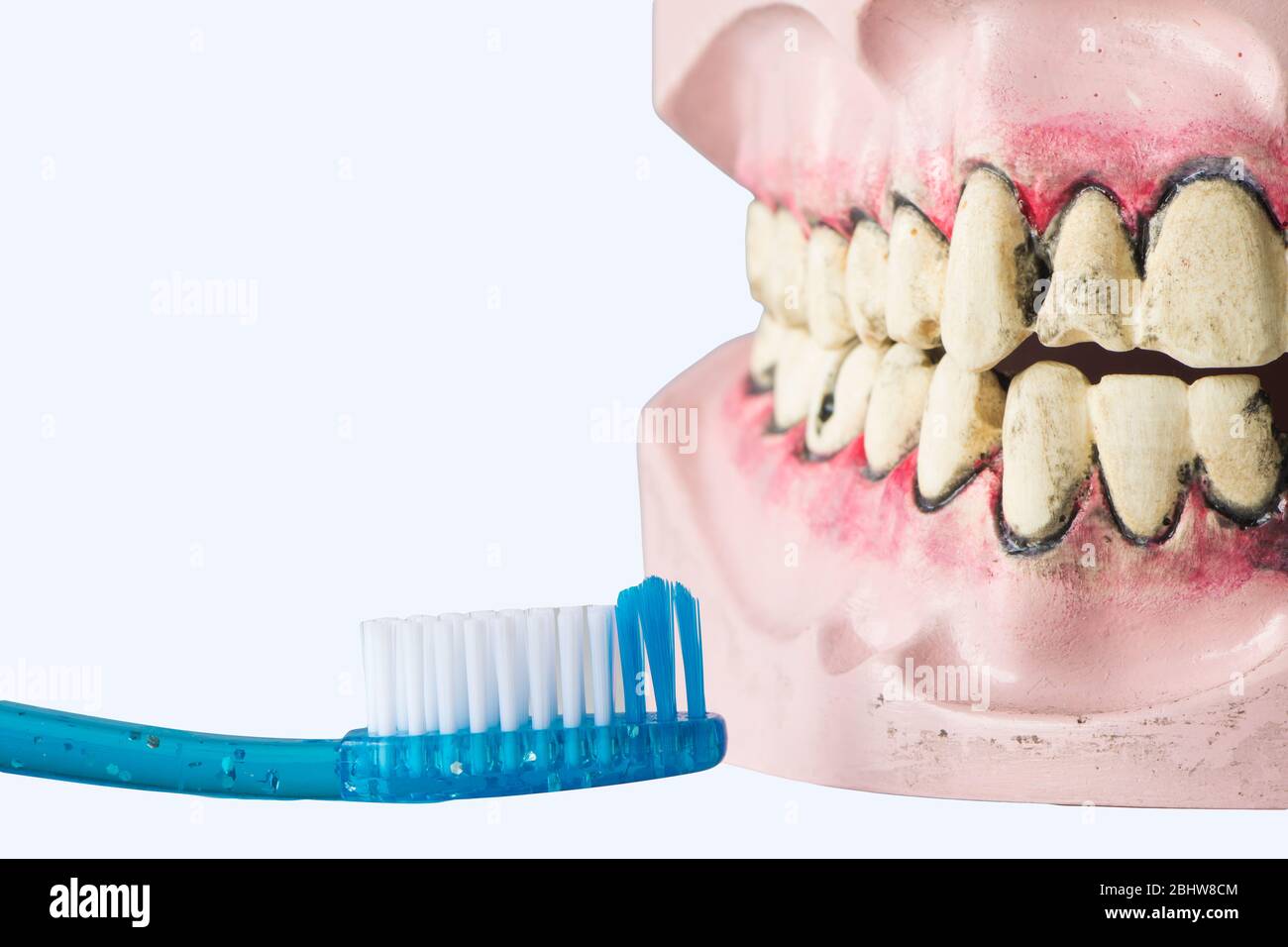 protesi dentaria con denti difettosi, gengive infettate e spazzolino da denti. dentature che mostrano cavità. Salute dentale per la prevenzione. Foto Stock