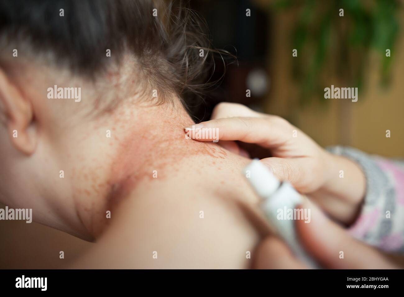 Un infermiere lubrificante danneggiato collo eczema da guarire unguento, concetto di salute Foto Stock