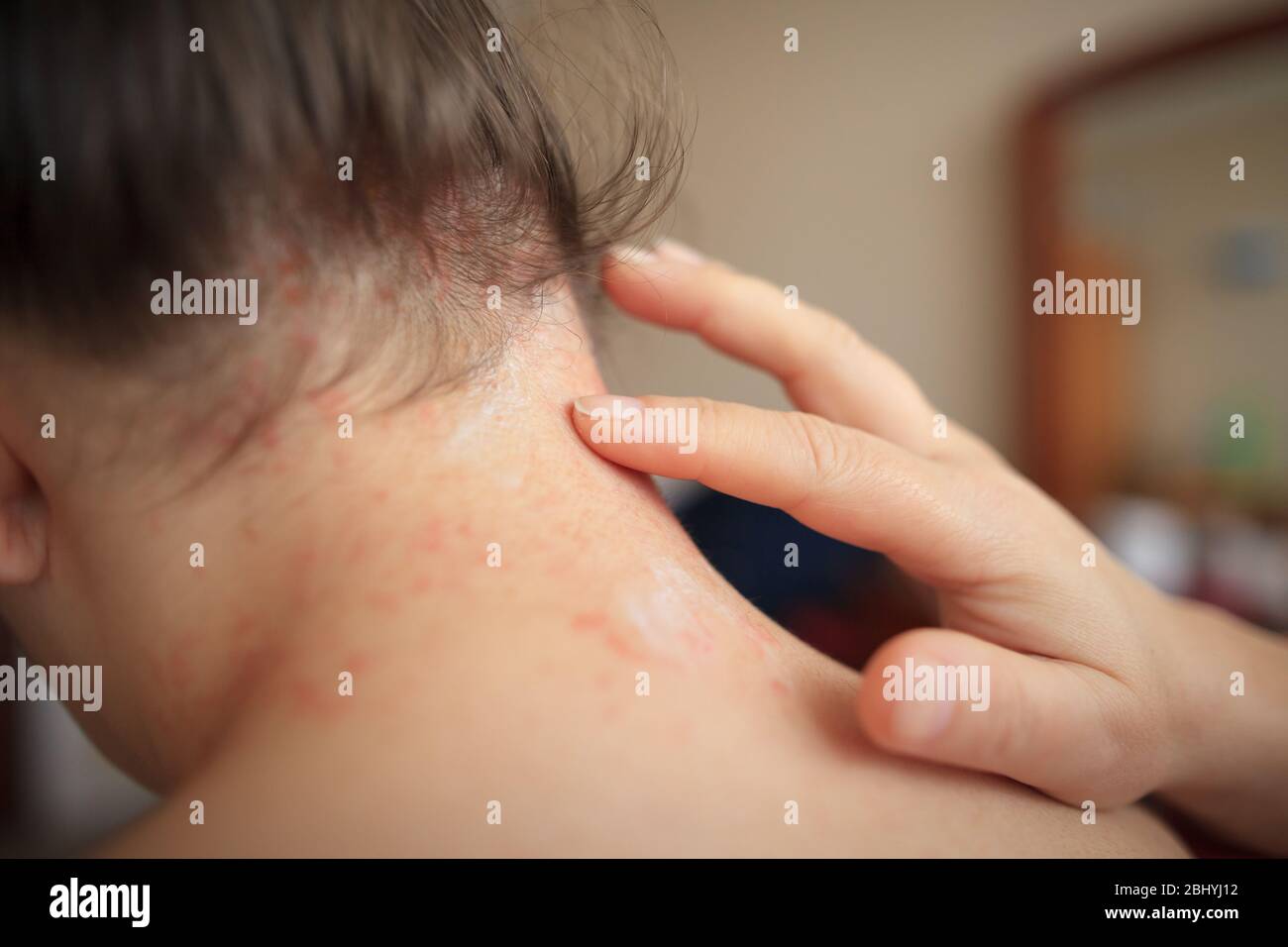 Le mani della donna lubrificano la pelle danneggiata sul collo con unguento healing, concetto di sanità Foto Stock