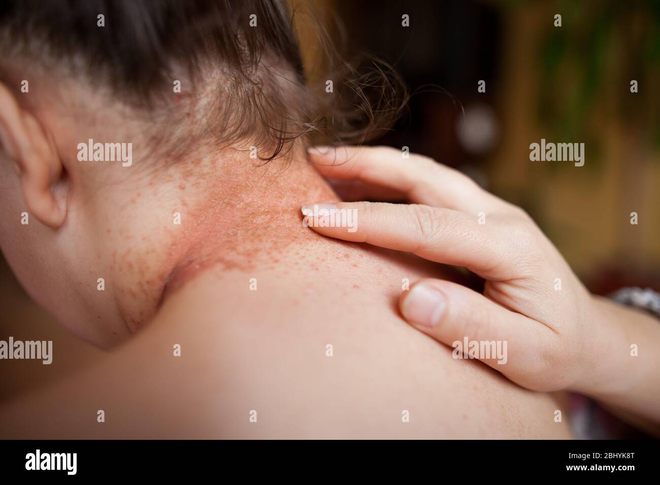 Le mani della donna lubrificano la pelle danneggiata sulla parte posteriore con unguento healing, concetto di sanità Foto Stock