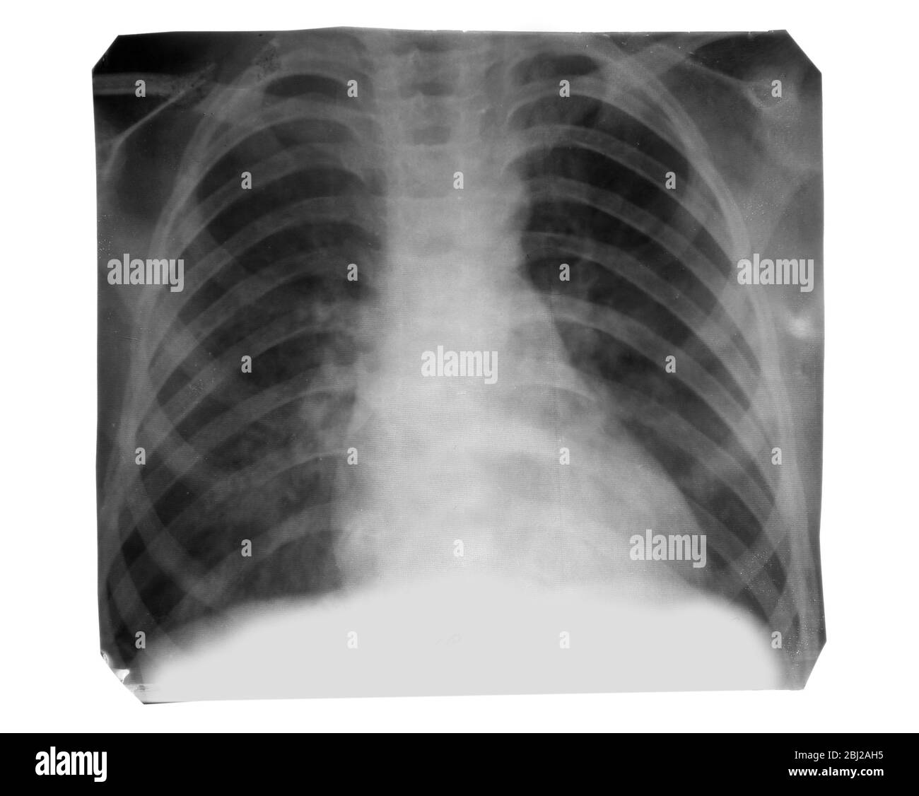 Immagine radiografica isolata su bianco Foto Stock