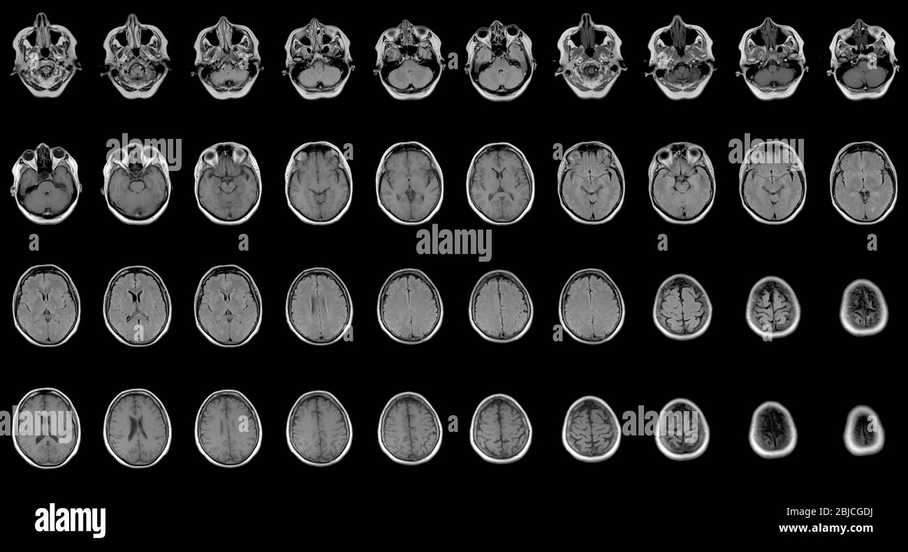Serie di scansioni MRI seriali di sessanta anni caucasiche testa femmina Foto Stock