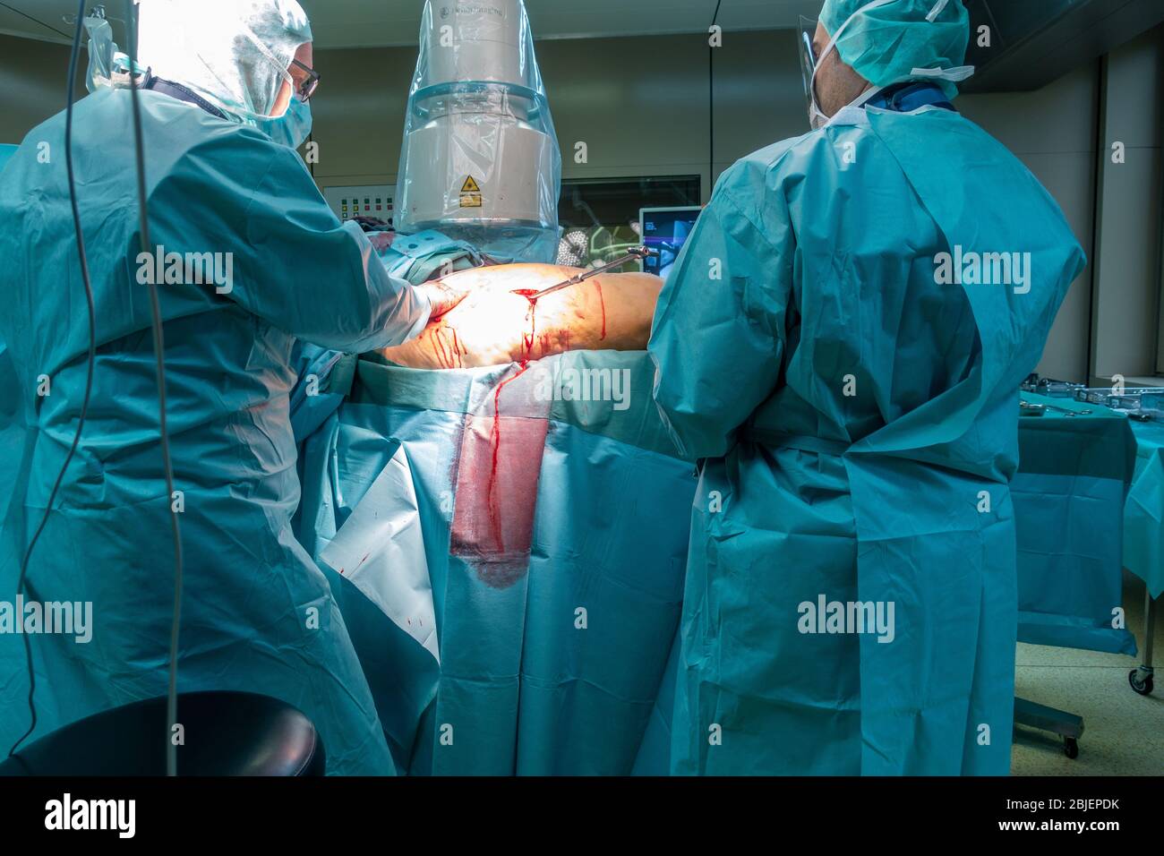 in una sala operatoria, un'operazione di protesi dell'anca viene eseguita da due medici Foto Stock