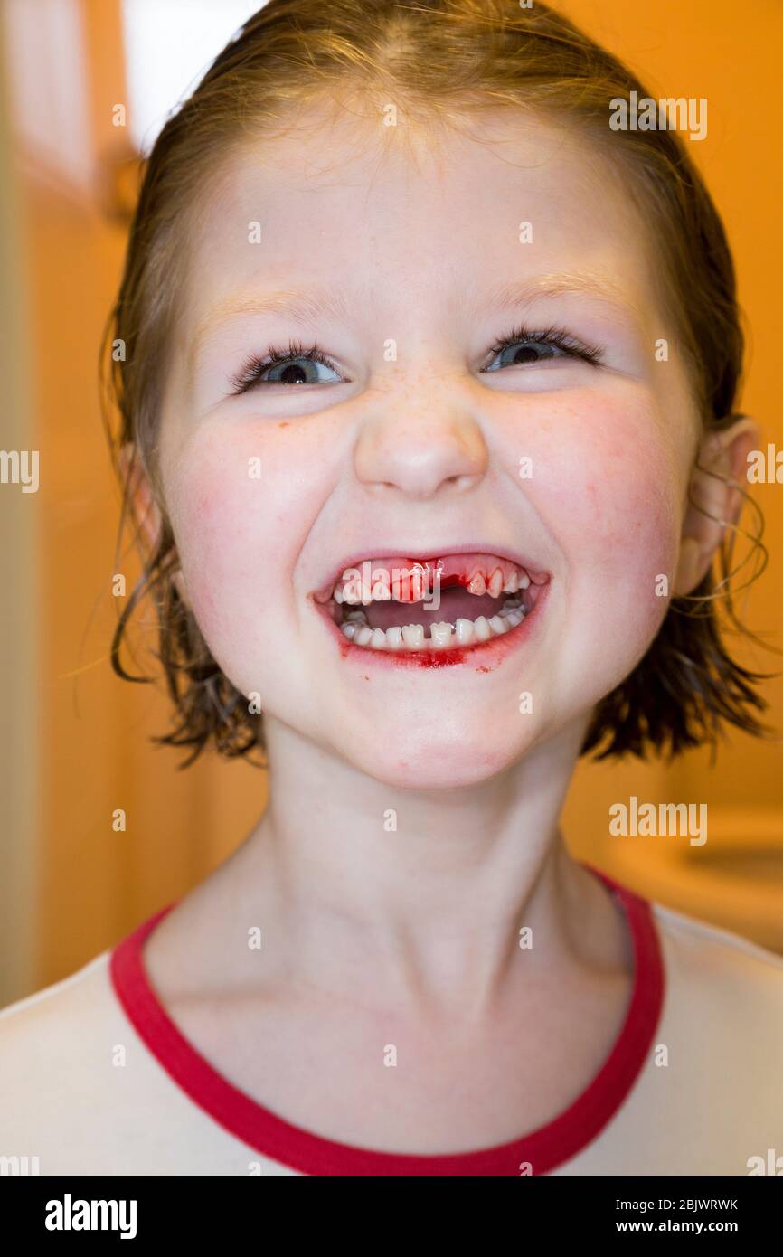 Un bambino di cinque anni che è felice e felice, dopo aver tirato fuori uno dei suoi denti di latte, un incisore superiore sciolto. La ferita sanguina con sangue per un attimo dopo. (119) REGNO UNITO Foto Stock