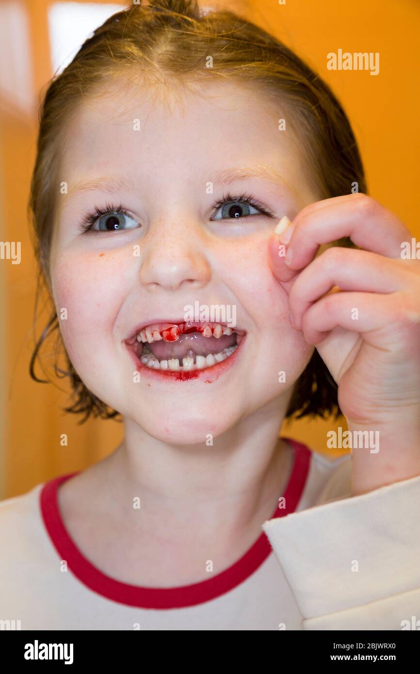 Un bambino di cinque anni che è felice e felice, dopo aver tirato fuori uno dei suoi denti di latte, un incisore superiore sciolto. La ferita sanguina con sangue per un attimo dopo. (119) REGNO UNITO Foto Stock