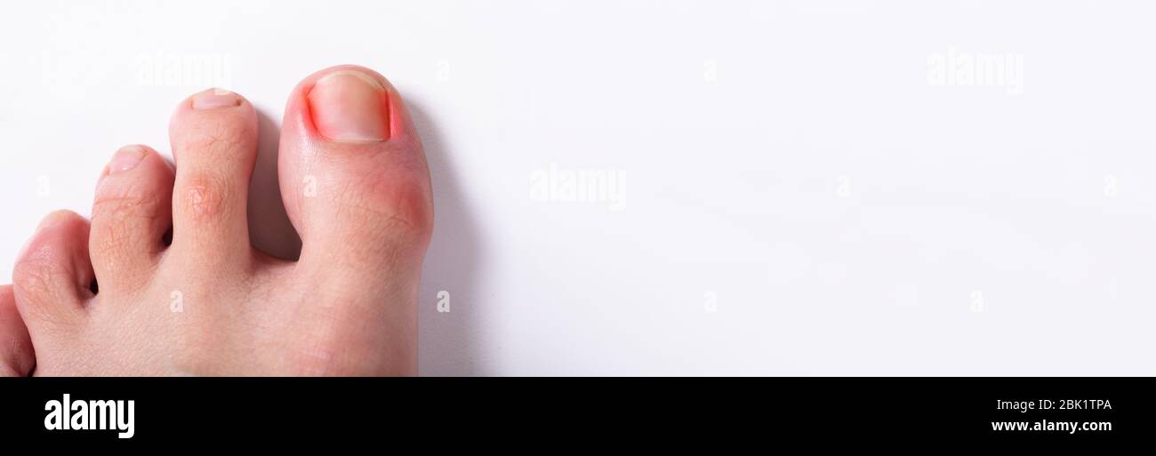 Toenail ingrown. Problema di chiodo infetto e irritato Foto Stock