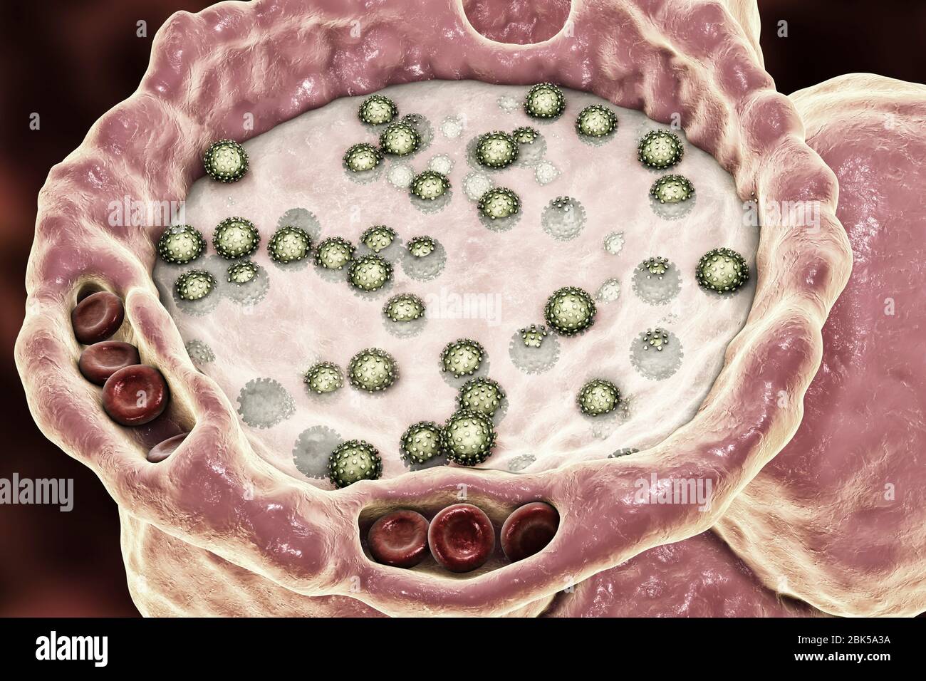 Alveoli umani riempiti di liquido e virus SARS-cov-2 durante l'infezione da COVID-19, illustrazione concettuale del computer. Foto Stock