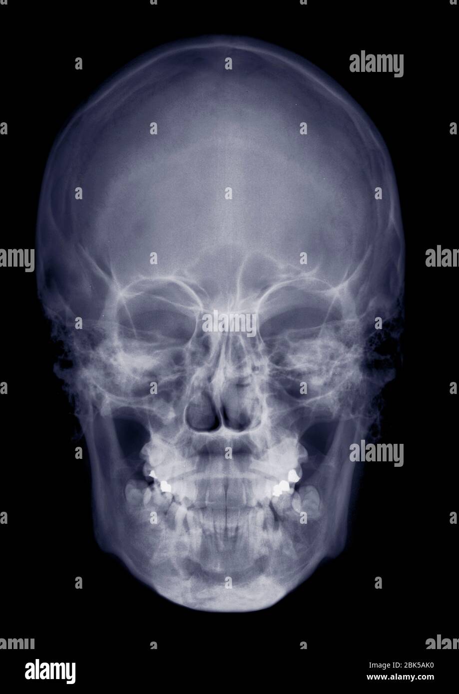 Cranio umano dal davanti, raggi X. Foto Stock