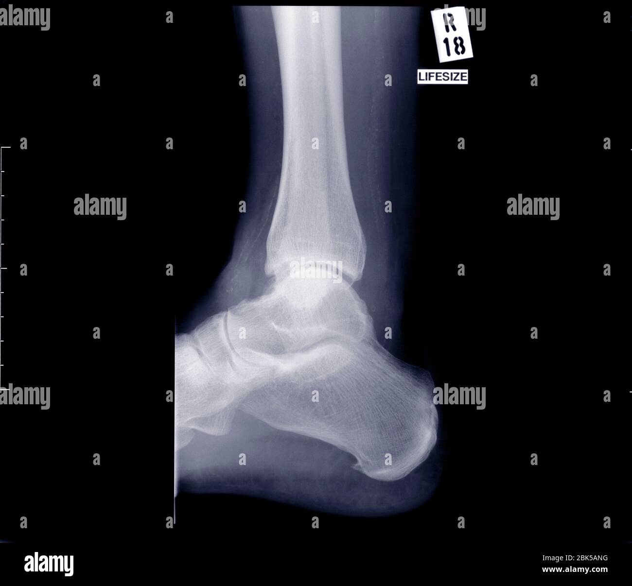 Articolazione della caviglia laterale, raggi X. Foto Stock