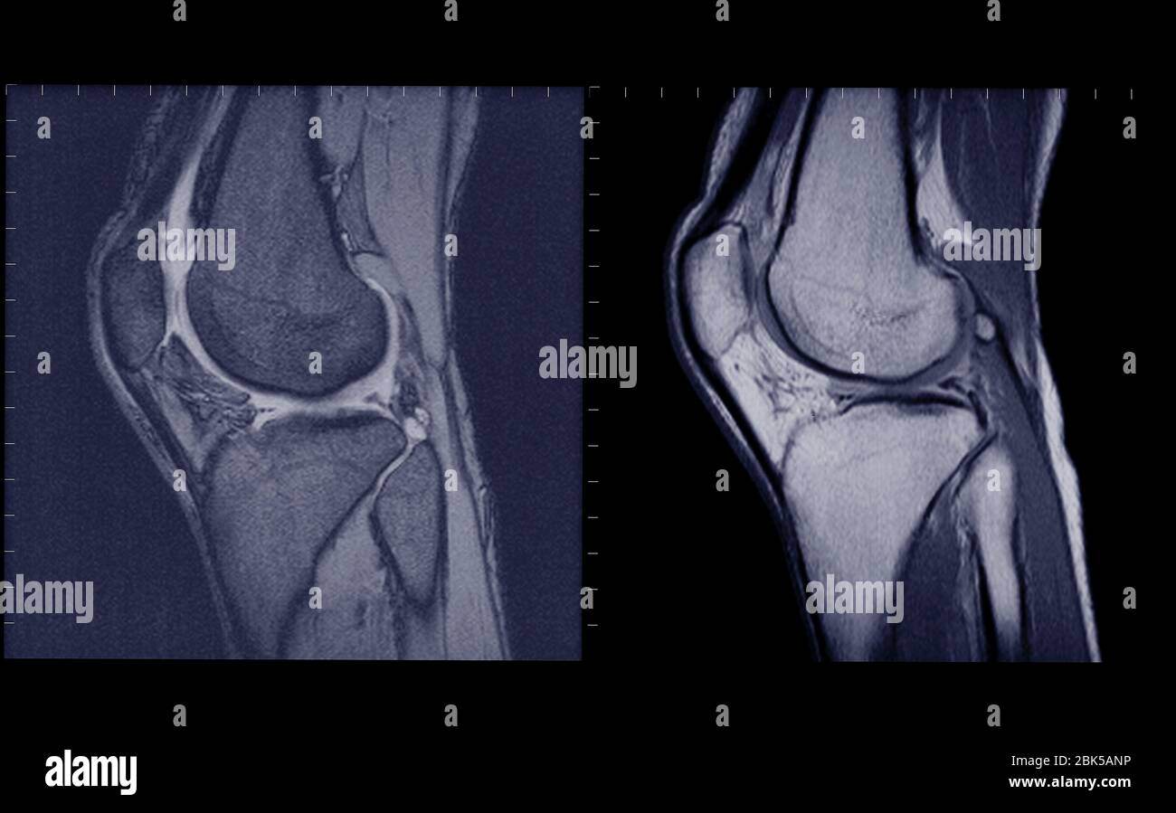 Vista laterale articolazioni ginocchia, MRI. Foto Stock