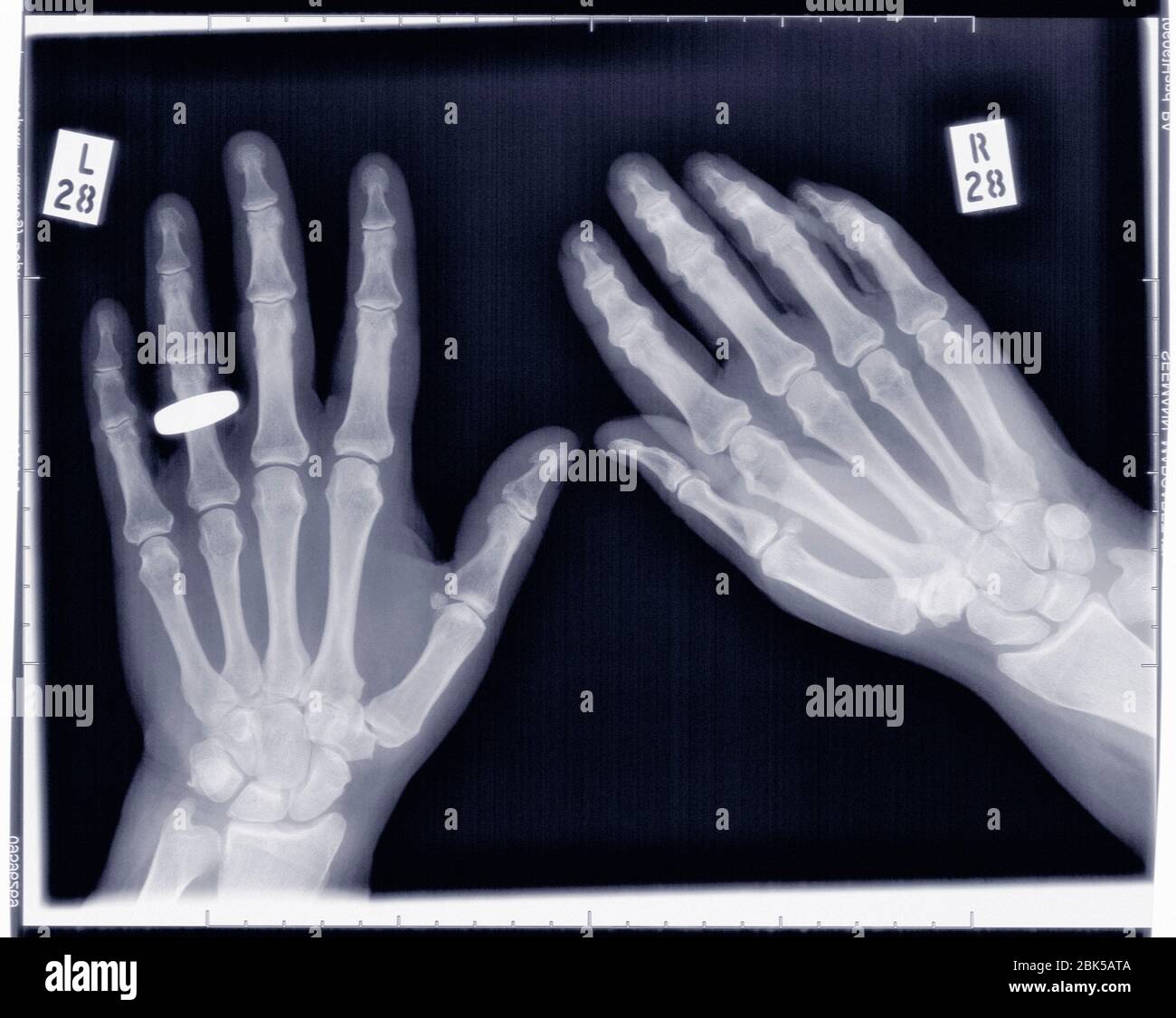 Mani con anello di nozze sulla mano sinistra, raggi X. Foto Stock