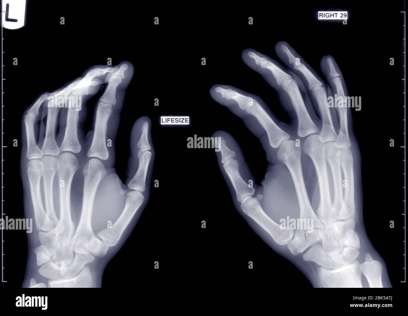 Mani leggermente arcuate, raggi X. Foto Stock