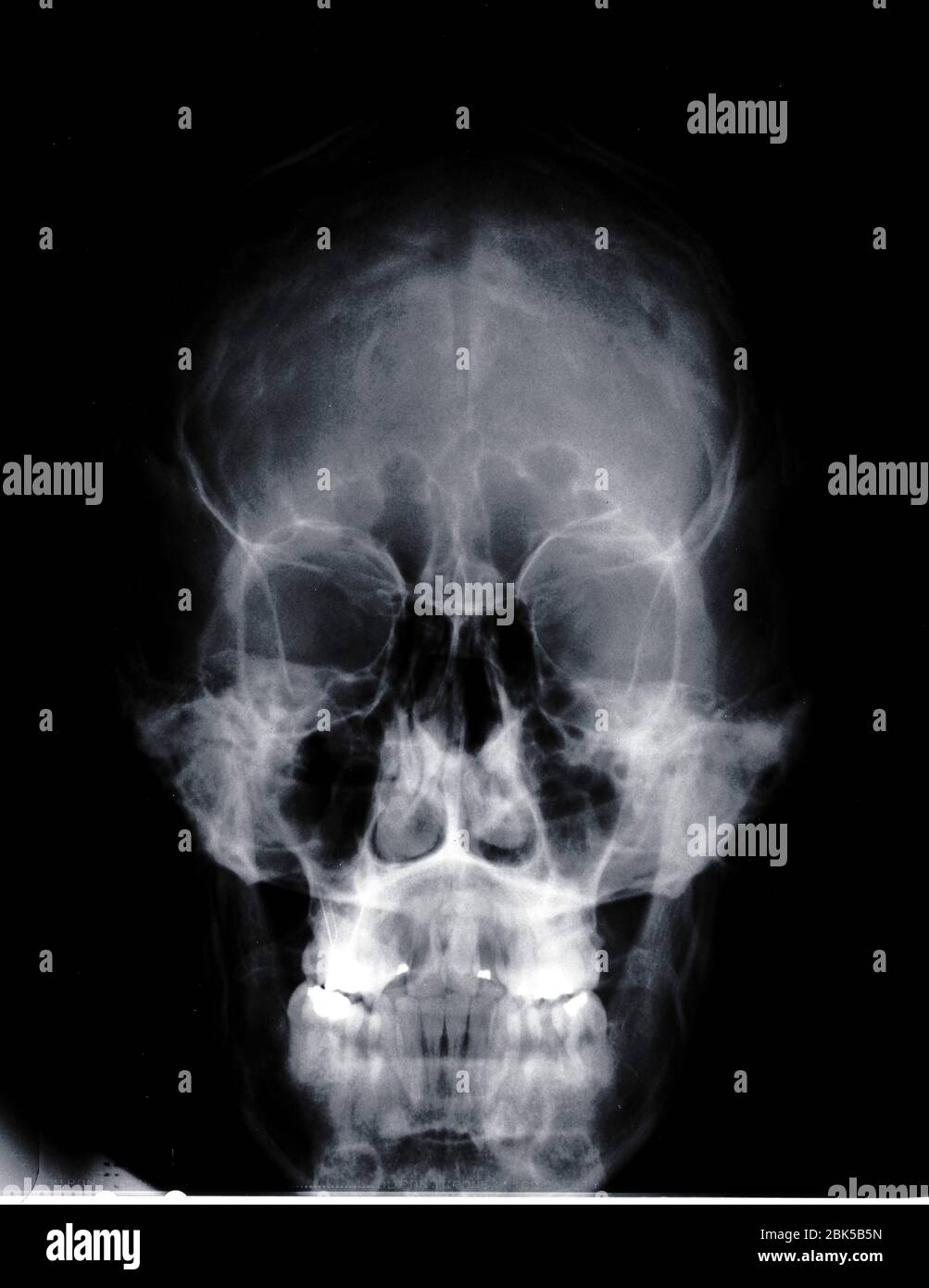Cranio umano, i raggi x. Foto Stock