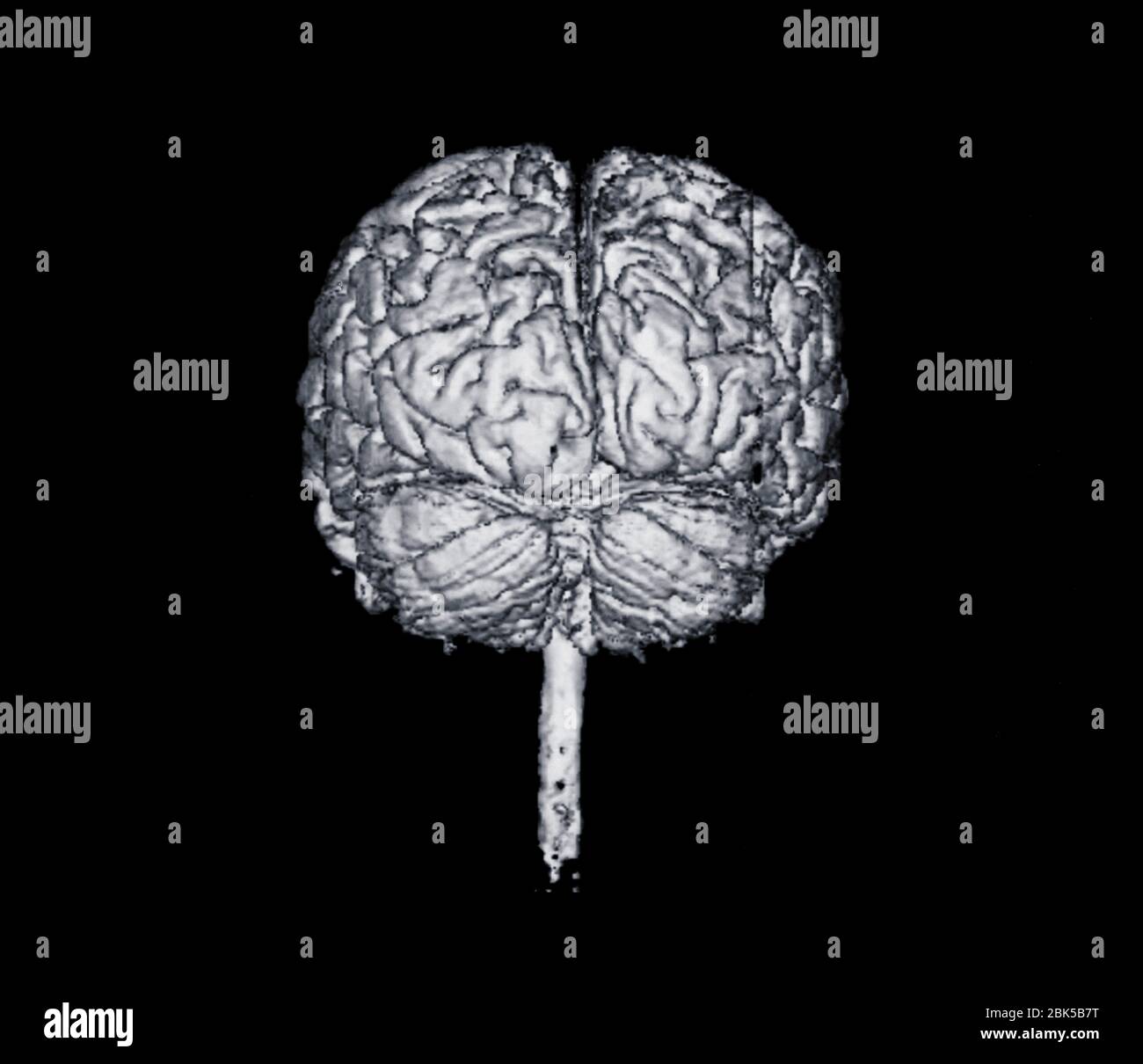 Vista frontale del cervello, raggi X. Foto Stock
