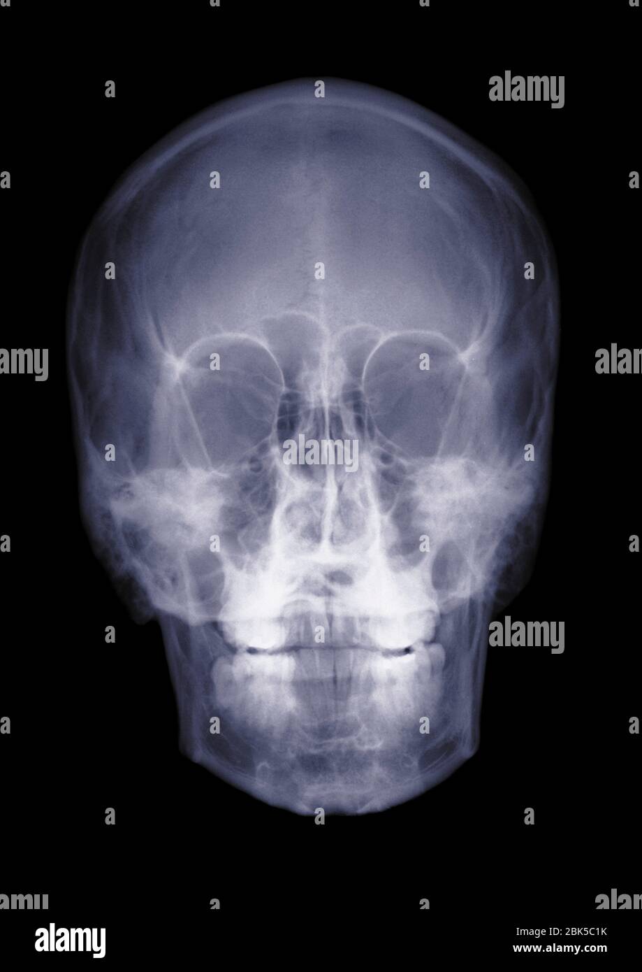 Cranio umano, i raggi x. Foto Stock