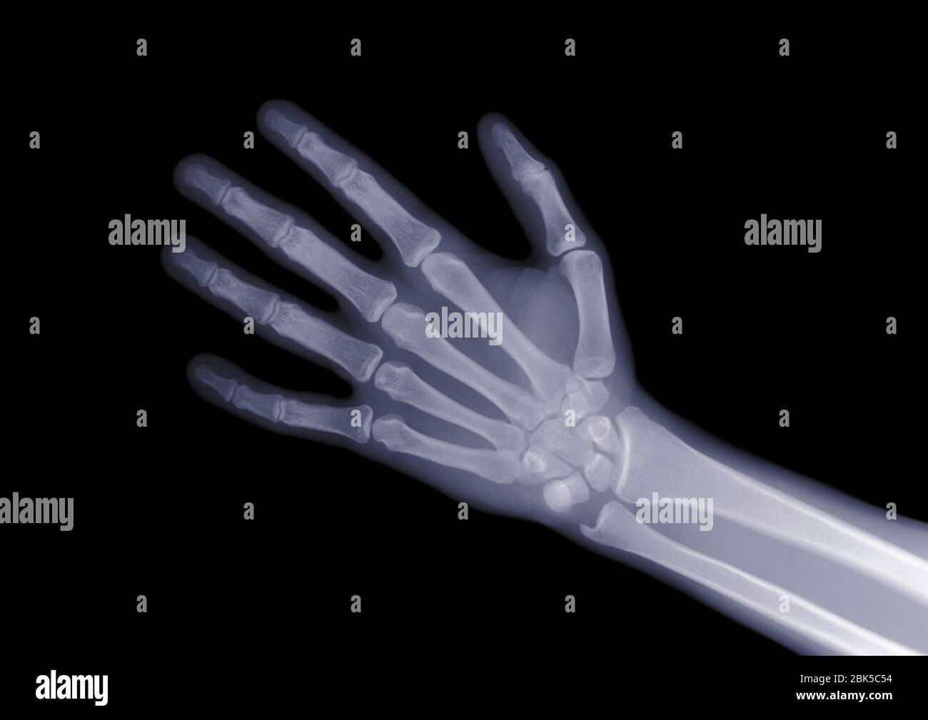Mano aperta, raggi X. Foto Stock