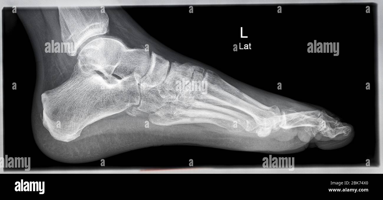 radiografia, immagine radiografica di un piede sinistro umano Foto Stock