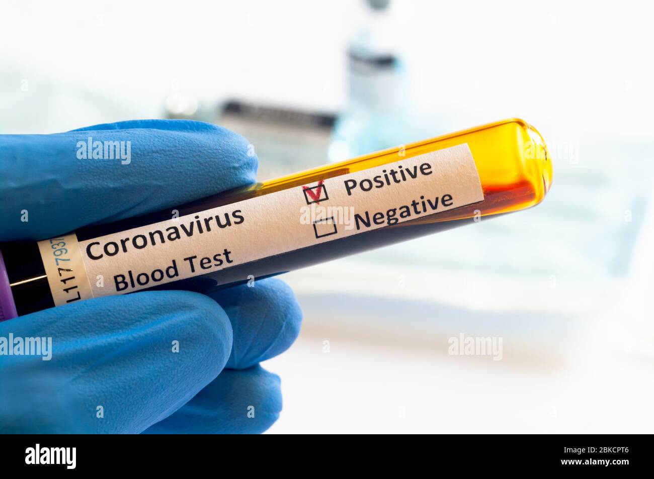 Pazienti sottoposti a test di tenuta di mano campioni ematici per l'epidemia di coronavirus (COVID-19) in laboratorio, New Coronavirus SARS-cov-2 Foto Stock