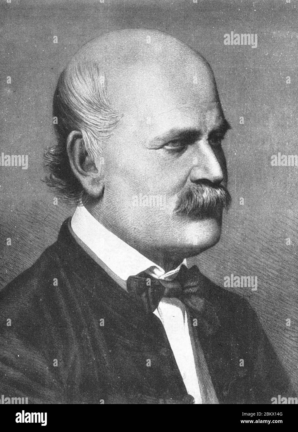 Ignaz Semmelweis 1860. Foto Stock