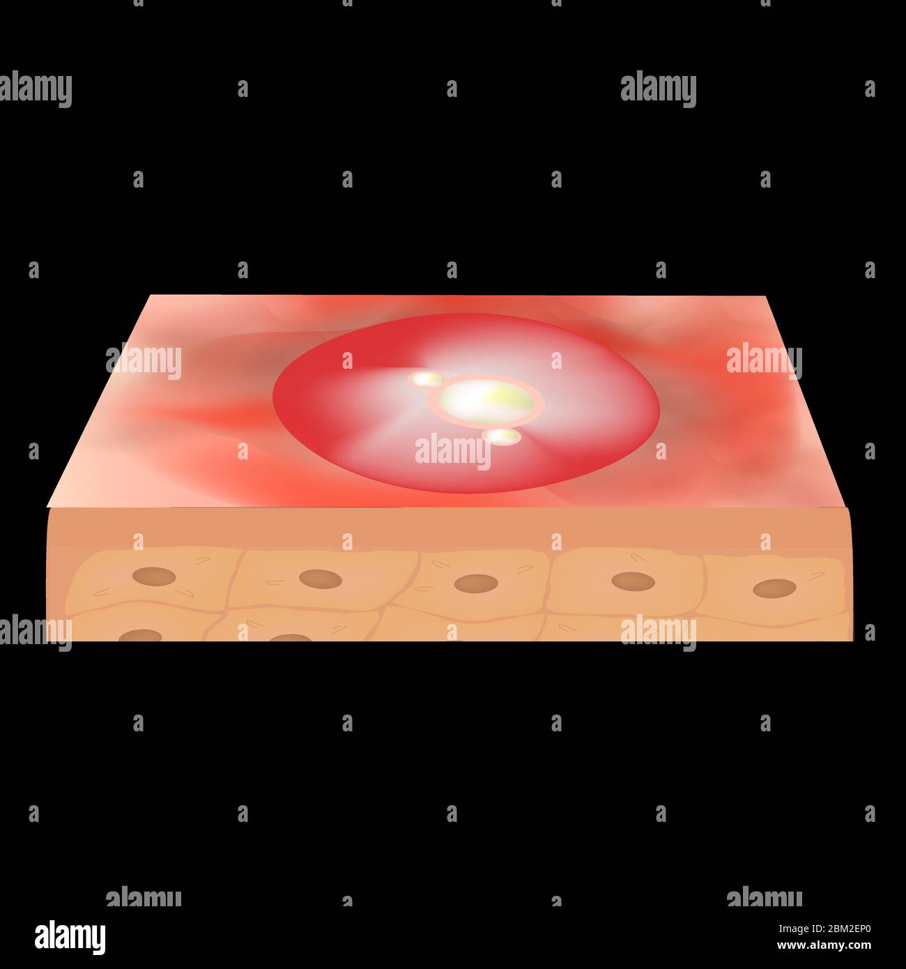 Cisti acne. Furuncle Acne sulla pelle cisti e pimples. Malattie infiammatorie dermatologiche e cosmetiche sulla pelle del viso. Infografica Illustrazione Vettoriale