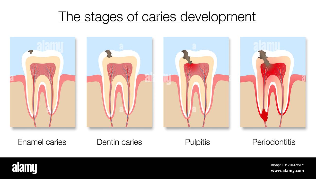 Tabella delle fasi carie, sviluppo della carie dentaria con caramelle smalto e dentina, polpite e periodontite - illustrazione su sfondo bianco. Foto Stock