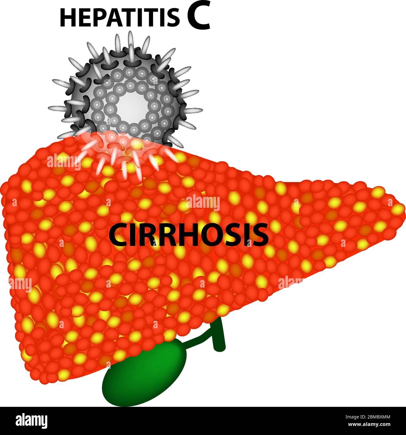 L'epatite C porta allo sviluppo di cirrosi nel 97% dei casi. Infografica. Illustrazione vettoriale su sfondo isolato Illustrazione Vettoriale