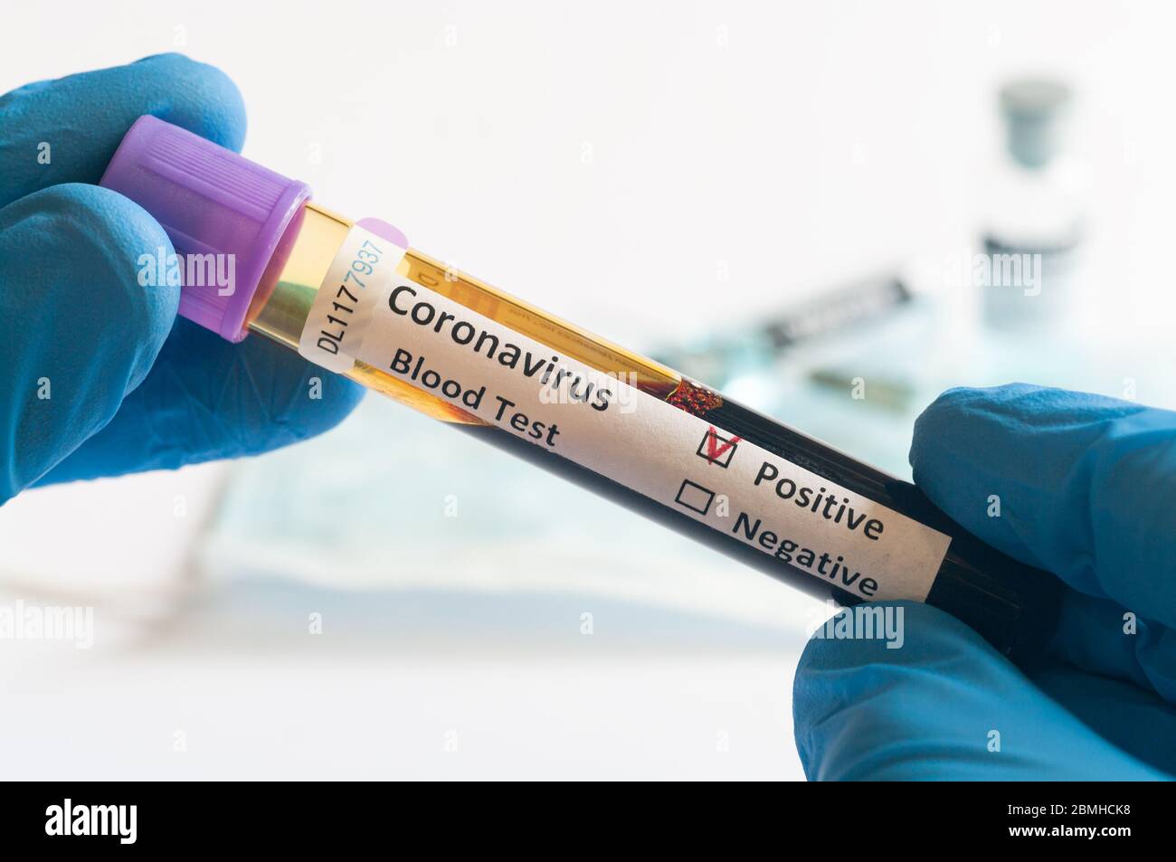 Pazienti sottoposti a test di tenuta di mano campioni di sangue per l'epidemia di coronavirus (COVID-19) in laboratorio, New Coronavirus 2019-nCoV. Foto Stock