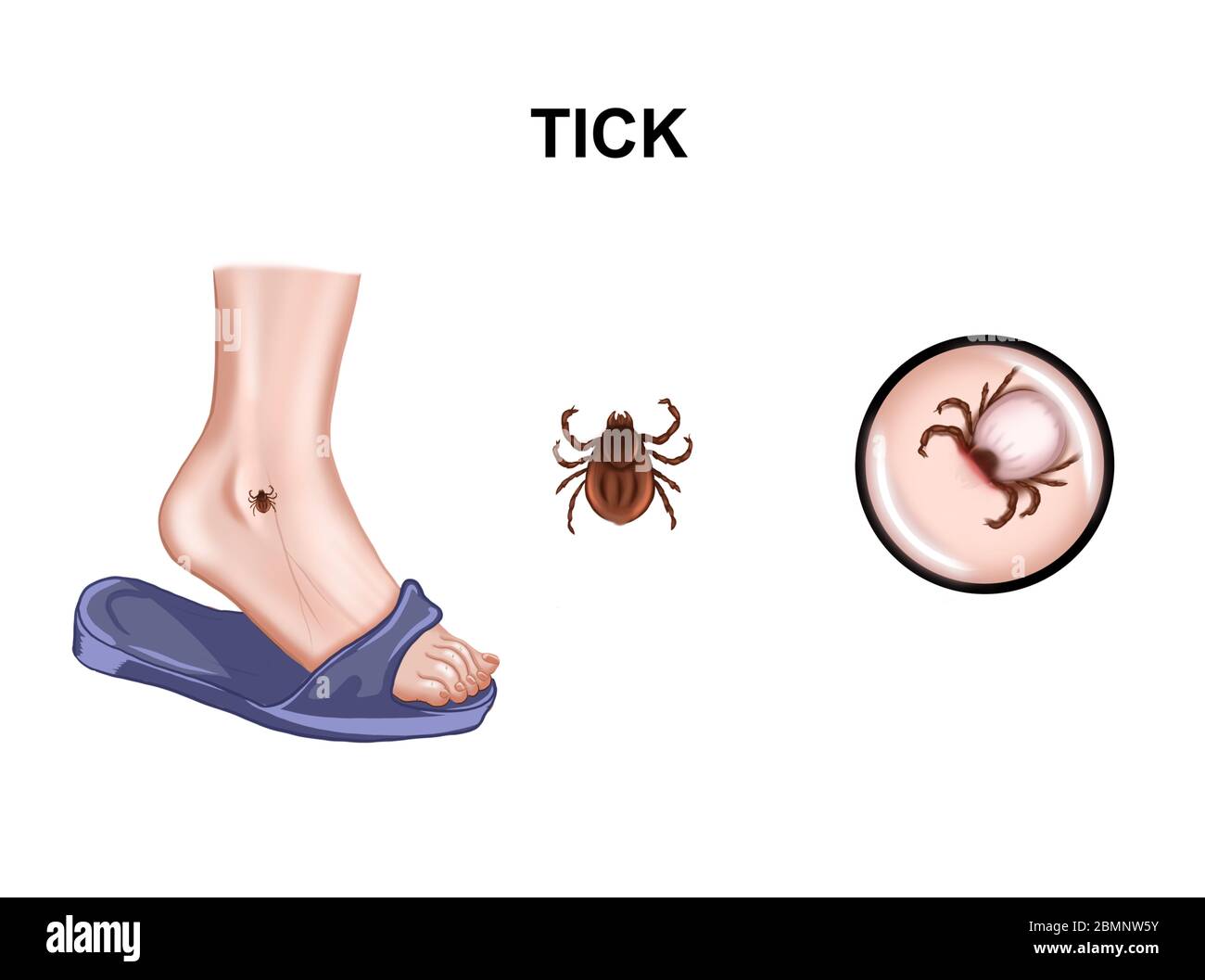Illustrazione del morso di zecca dell'encefalite Foto Stock