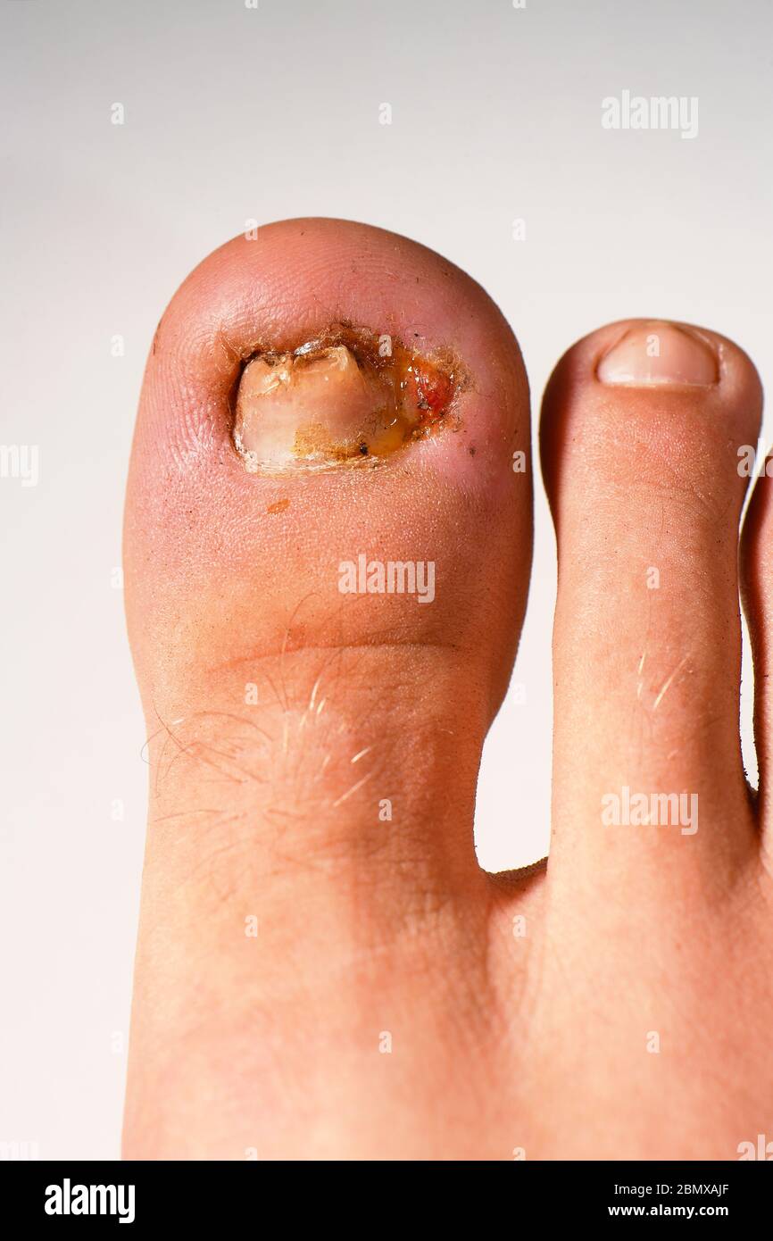 Ingrown toenail che ha bisogno di trattamento per curare il problema. Foto Stock