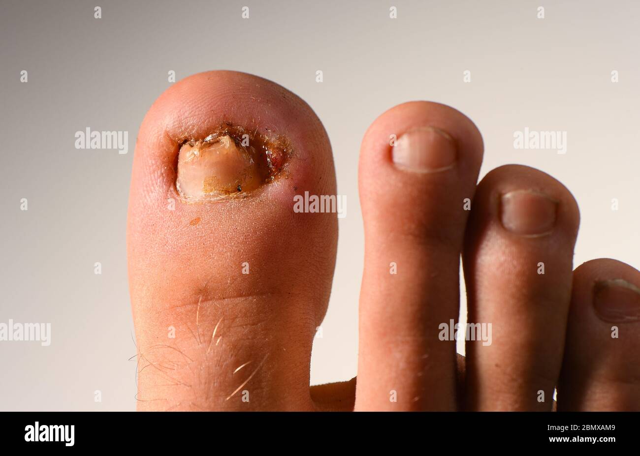 Ingrown toenail che ha bisogno di trattamento per curare il problema. Foto Stock