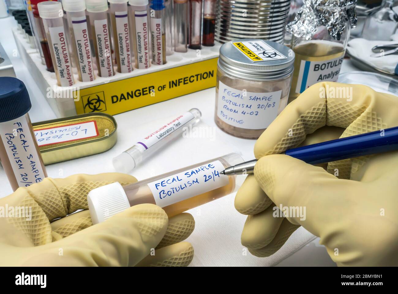 Uno scienziato specializzato scrive sull'etichetta del campione fecale, infezione botulistica in persone ammalate, immagine concettuale Foto Stock