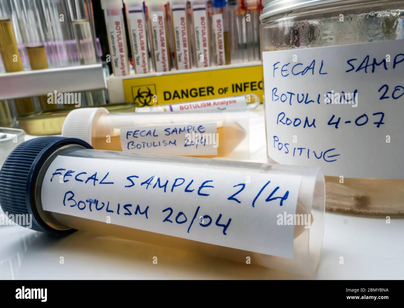 Campione fecale di una persona infetta da botulismo, infezione in lattine in cattive condizioni, immagine concettuale Foto Stock