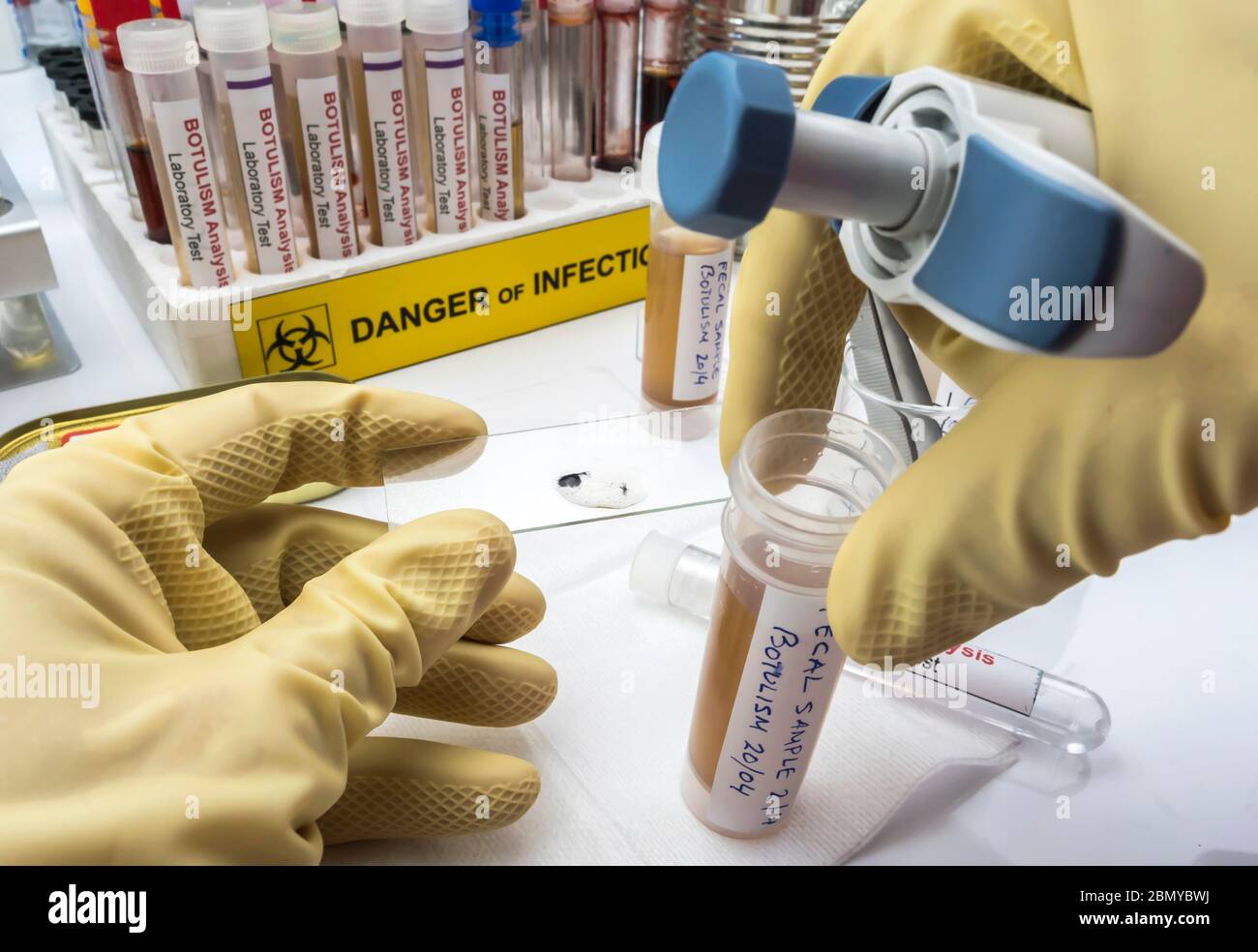 Esperto scienziato di laboratorio che analizza un campione fecale, infezione botulistica in persone ammalate, immagine concettuale Foto Stock