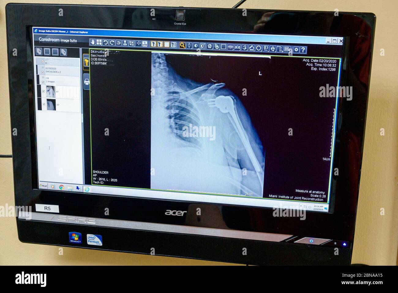 Miami Florida, Coral Gables, medico medico ufficio medico sala esame esame, rotto spalla ferita riparazione trattamento, raggi X, FL200217061 Foto Stock